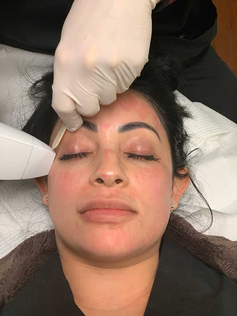 Venus Viva Facial Treatment